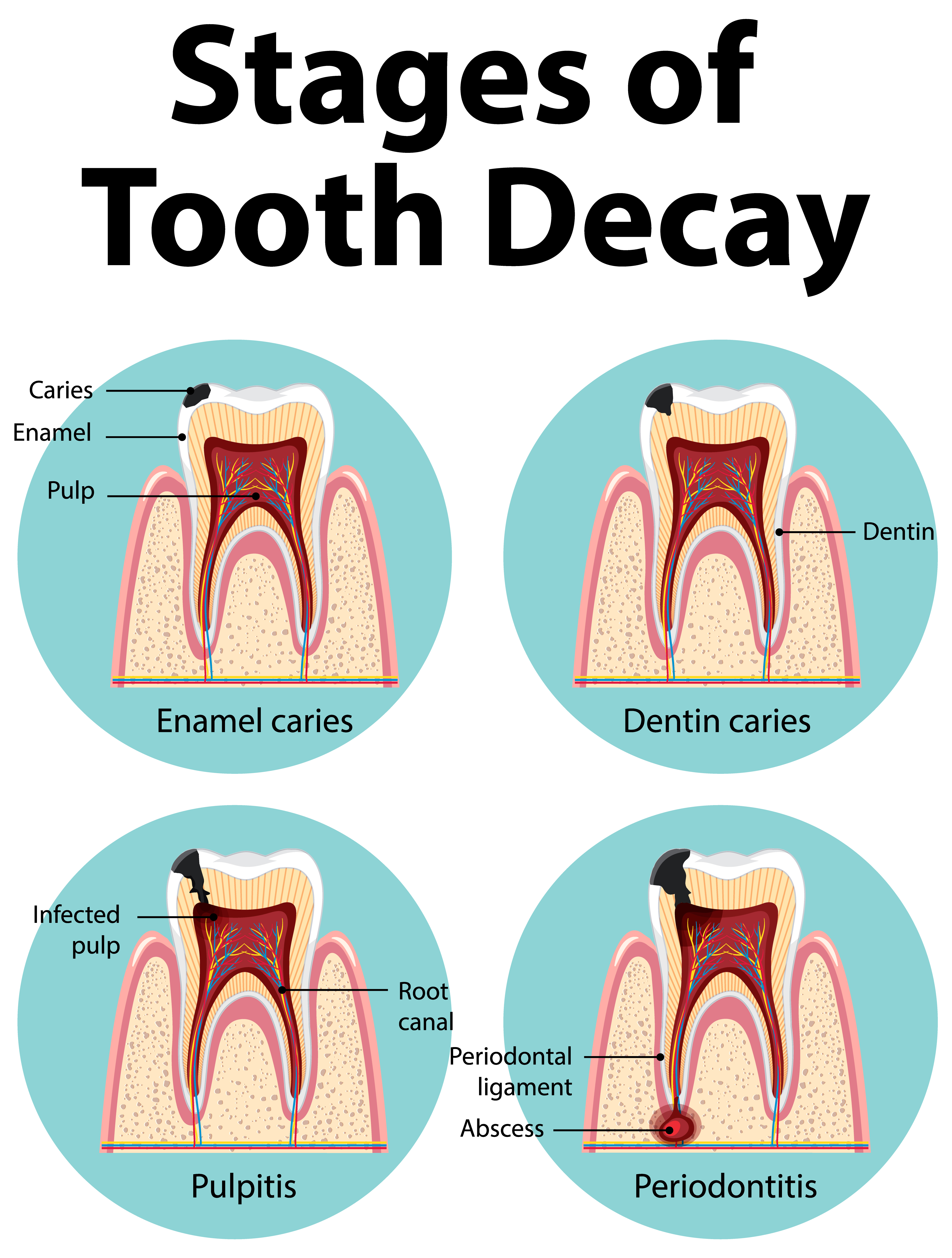 Root Canal Procedure