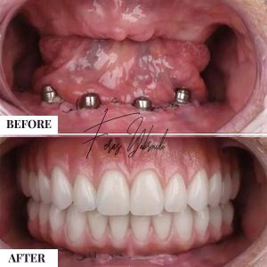 زراعة الأسنان وهشاشة العظام