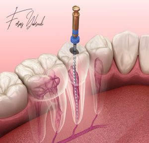 علاج قناة الجذر في عيادة الدكتور فراس