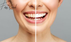 Comparison chart of All-on-6 implants, All-on-4 implants, and traditional dentures