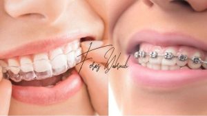 تقويم الأسنان التقليدي والشفاف