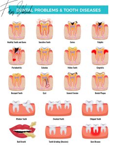 Sudden Tooth Fracture