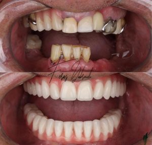 All-on-8 dental implants