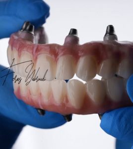 All-on-8 في عيادة متخصصة في دبي