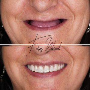 أطقم الأسنان الكاملة – استعادة الابتسامة بالكامل في عيادة الدكتور فراس يبرودي في دبي.