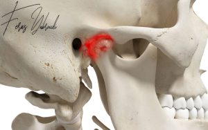 المفصل الفكي الصدغي المتضرر