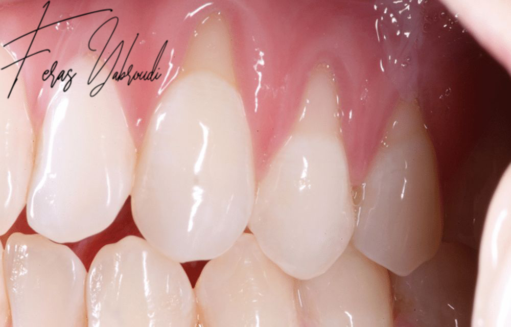 Receding gums treatment