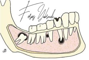 Oral and Jaw Cysts Treatment