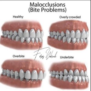 Malocclusion Treatment