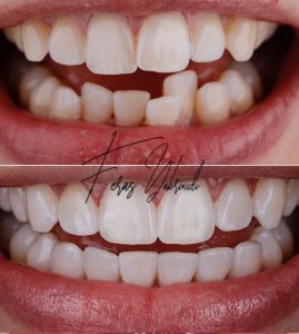 Teeth Reshaping and Whitening